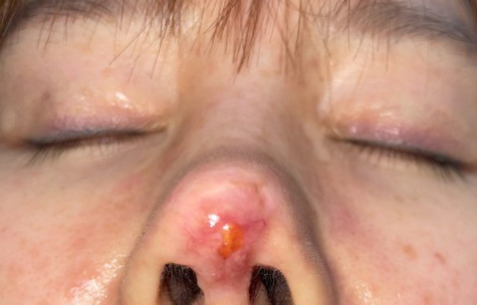 Gao's nose seen red and swollen