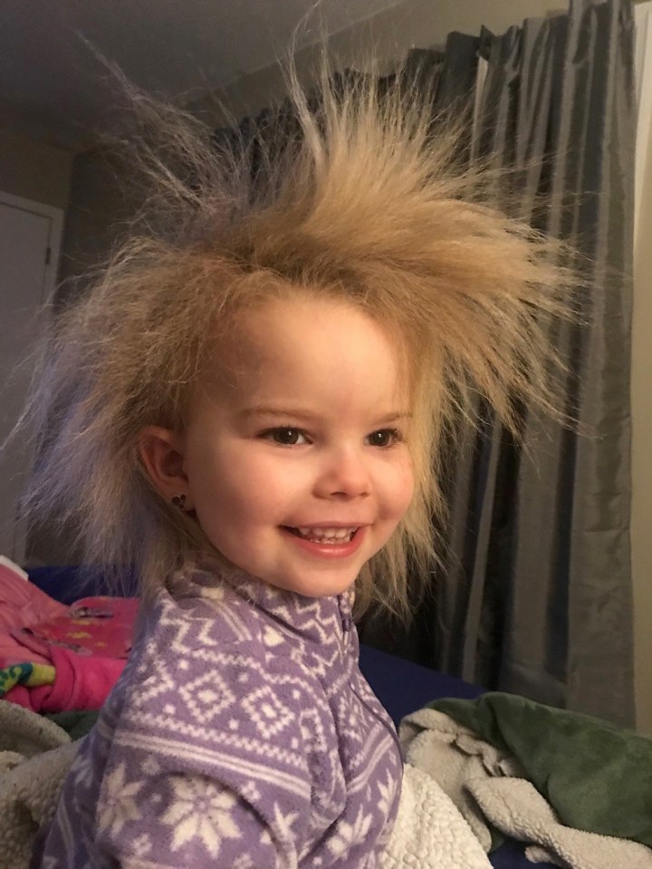 Zoey Freda, five, has uncombable hair syndrome