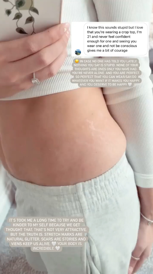 The star showed off her stretch marks