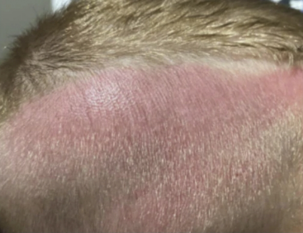 The mum claims the teachers hadn't told him to put on a hat or sunblock