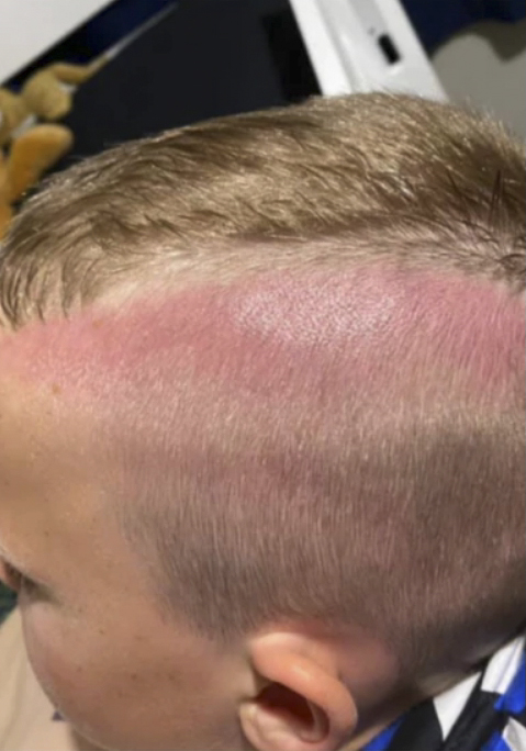 The eight-year-old came home from school with a very sunburnt head