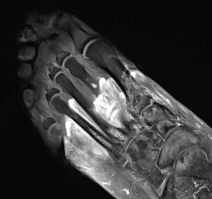 MRI of the foot in a patient with severe COVID-19. The grey part of the foot is devitalised tissue (gangrene)