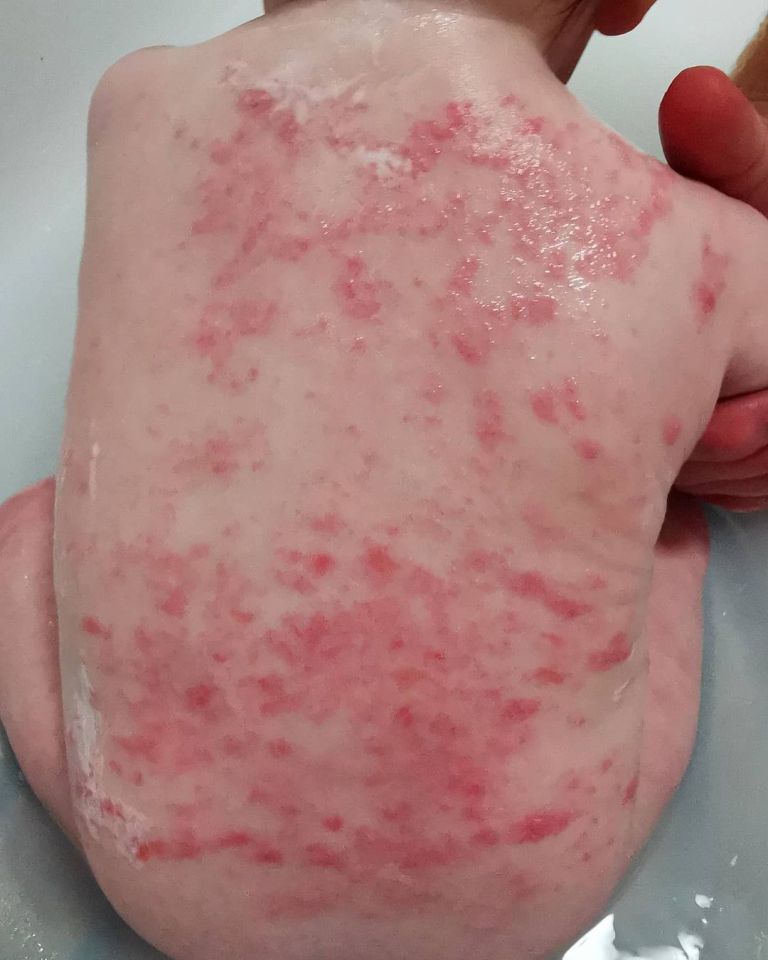 Pictured is a flare-up Arthur had on his back at nine months old - two months after he got treatment that worked to clear his skin