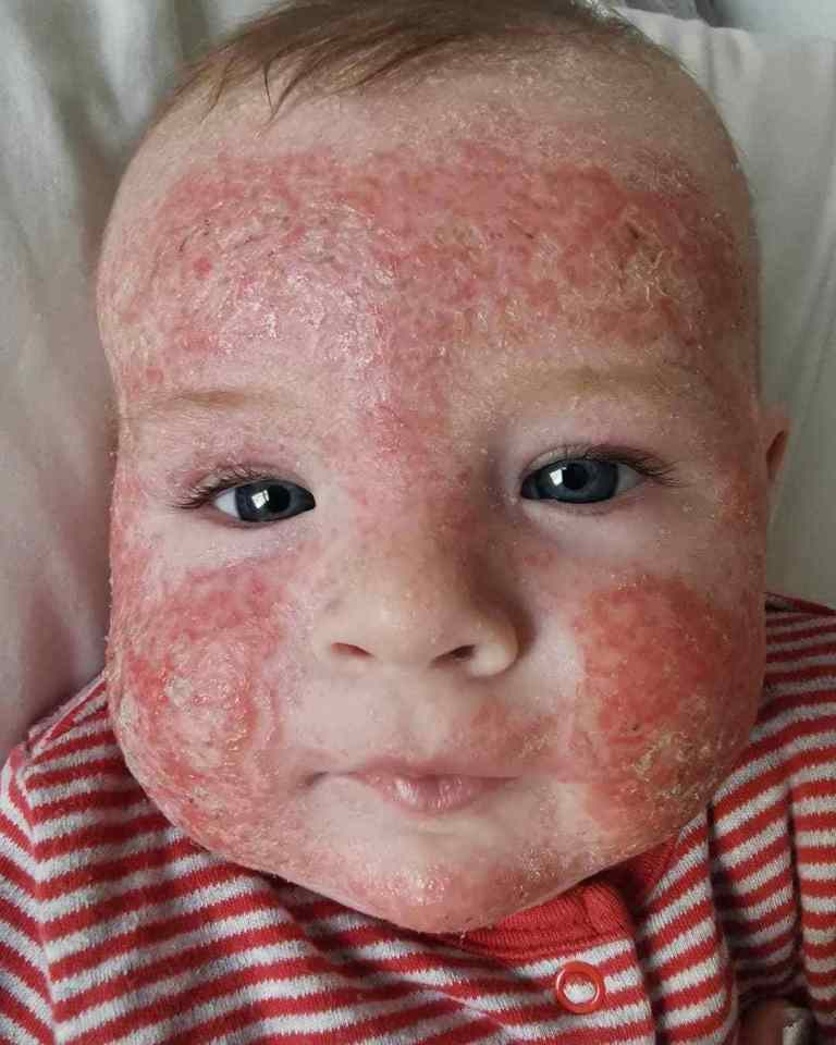 Arthur Smallwood, ten months old, suffers with a milk allergy causing eczema across his whole body. He is pictured at four months old