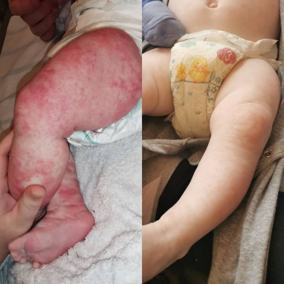 Arthur's legs pictured before treatment and after, at eight months old