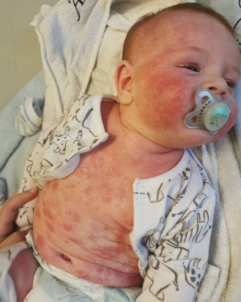 Charlotte Smallwood, 25, says her baby Arthur screamed in pain for seven months before he finally got the treatment he needed