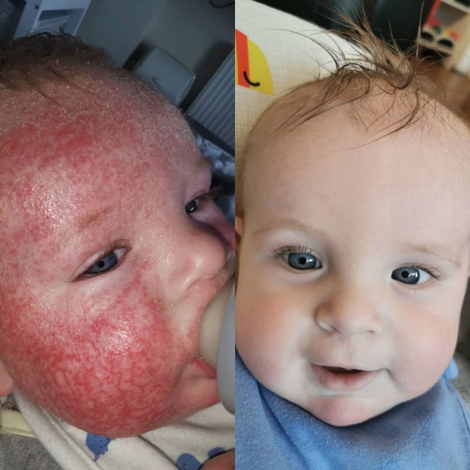 December 2020 - these pictures were taken just one week apart, before and after Arthur was put on a regime given by Homerton University Hospital Appointment