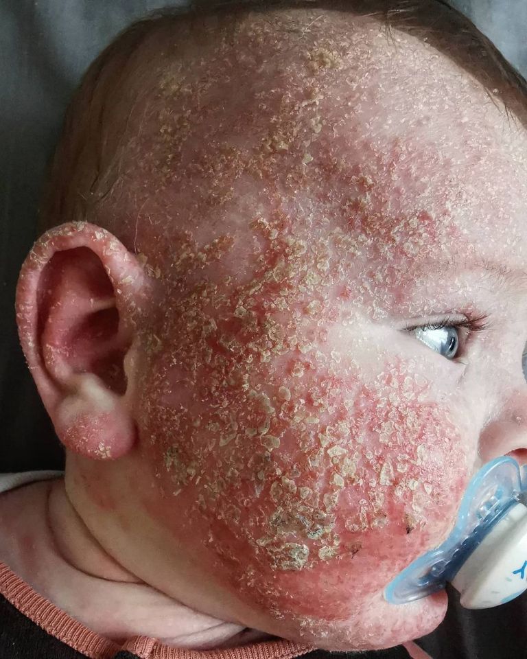 Arthur's skin when it was infected and blistered at seven months old