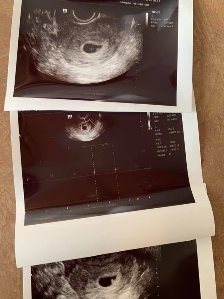 In September at their 28-week scan, Emily and Josh found out they were having a boy, and  named him Tucker