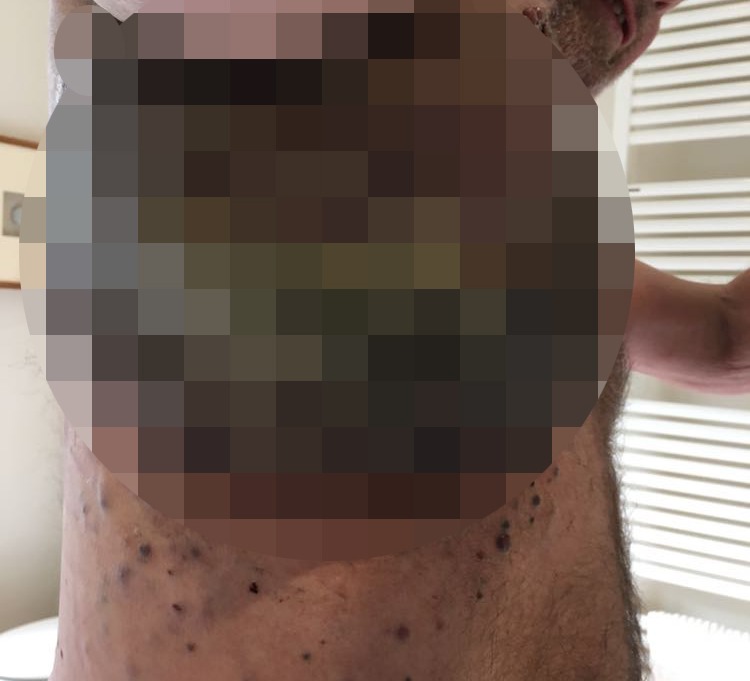 Before he died, the mole had grown from the size of a 'little blueberry' to expanding the entire underside of his arm