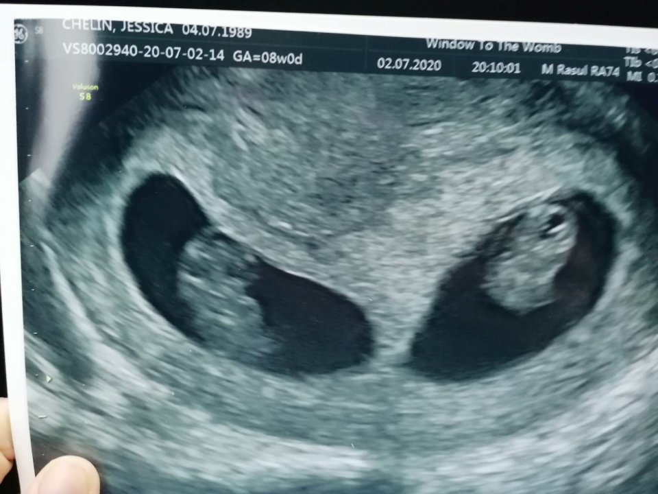 A scan picture from Jess' pregnancy