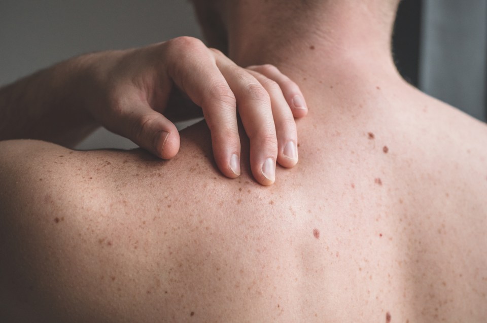 Dermatologist Anton Alexandroff says 'It might be a good idea to get your moles checked by a GP or dermatologist'