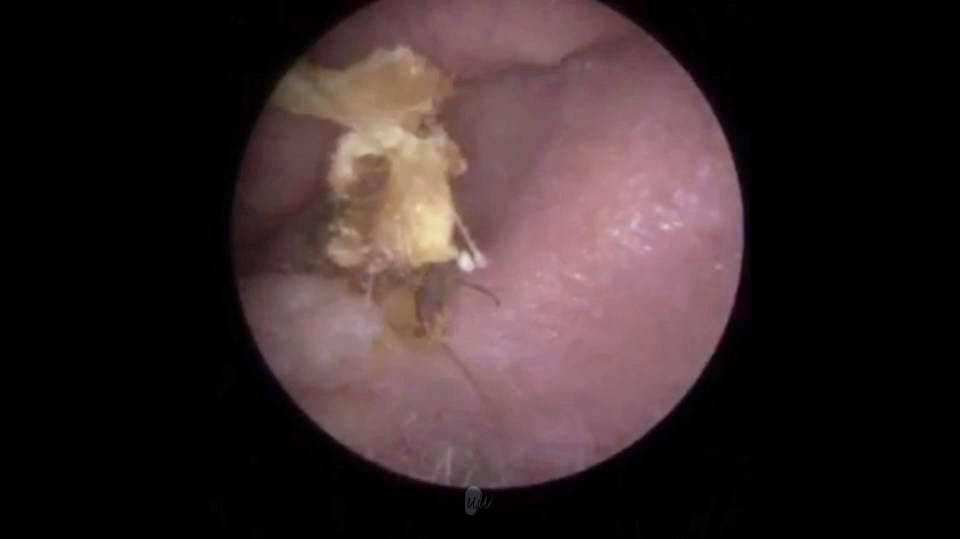 The image above shows the wax inside the patient's ear, before Dr Neel was able to remove it