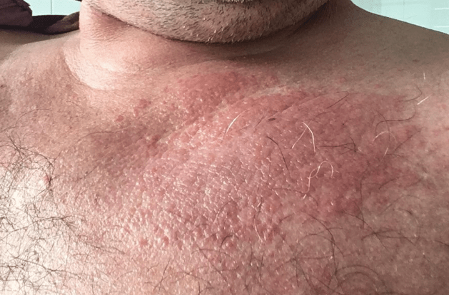 A man with eczema on his chest