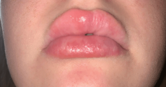 Some patients suffer swollen lips