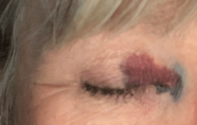 Purpuric rash on the corner of an eye