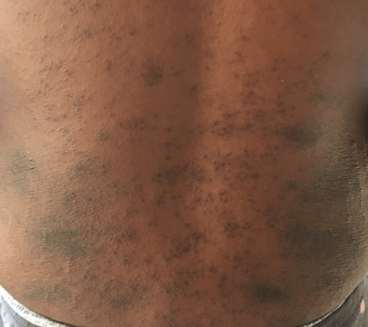 Papular and vesicular rash resembles prickly heat