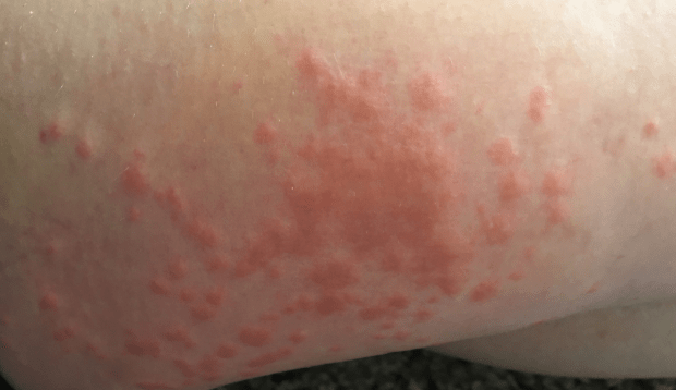 Papular and vesicular rash is very itchy, dermatologists said