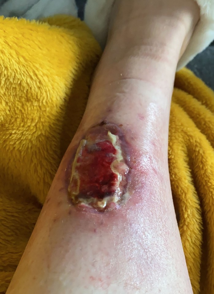 Lucy needed a skin graft to cover the crater left in her leg from removing the skin cancer. It got infected while she recovered from the surgery (pictured)