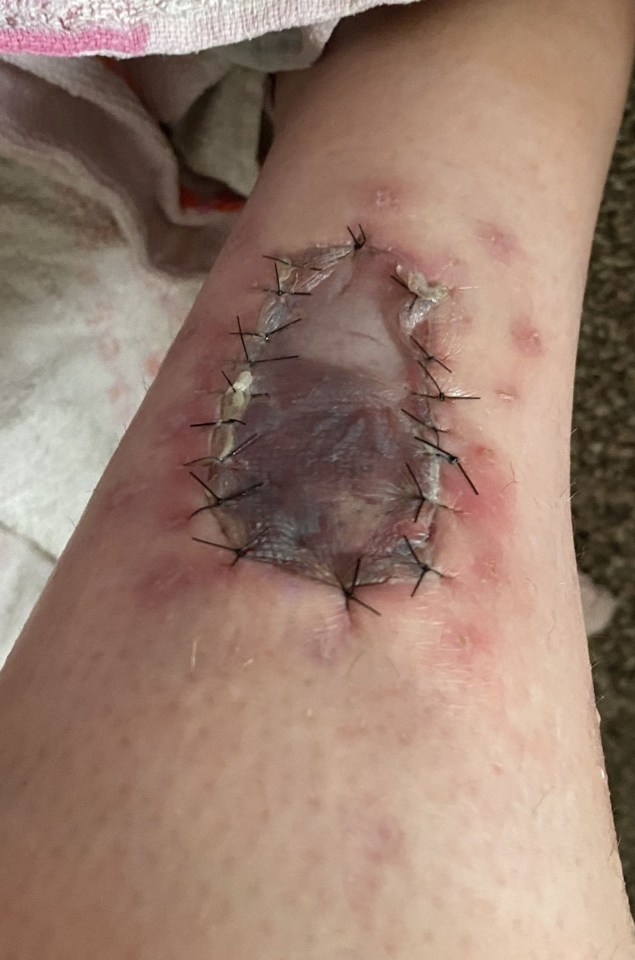 Lucy’s leg after the skin graft was attached