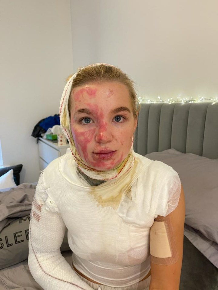 Abbie was left with third degree burns after filming a life hack video