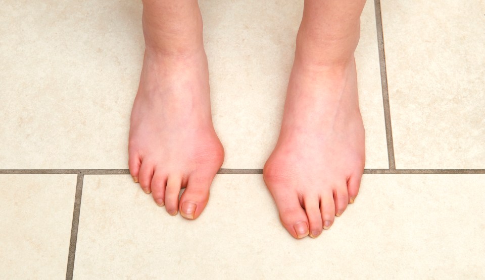 Bunions are hard, bony lumps on the side of your foot by your big toes