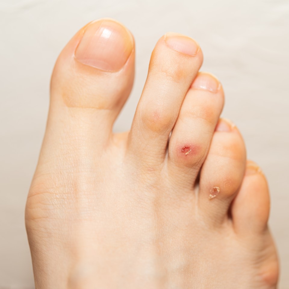 A callus is a thick, yellowish lump of dead skin