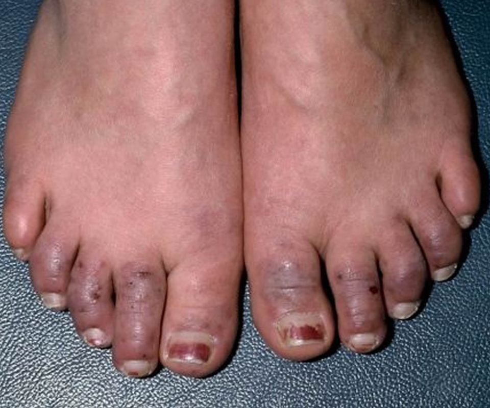 If you have cold feet regularly, it could be a sign of poor circulation