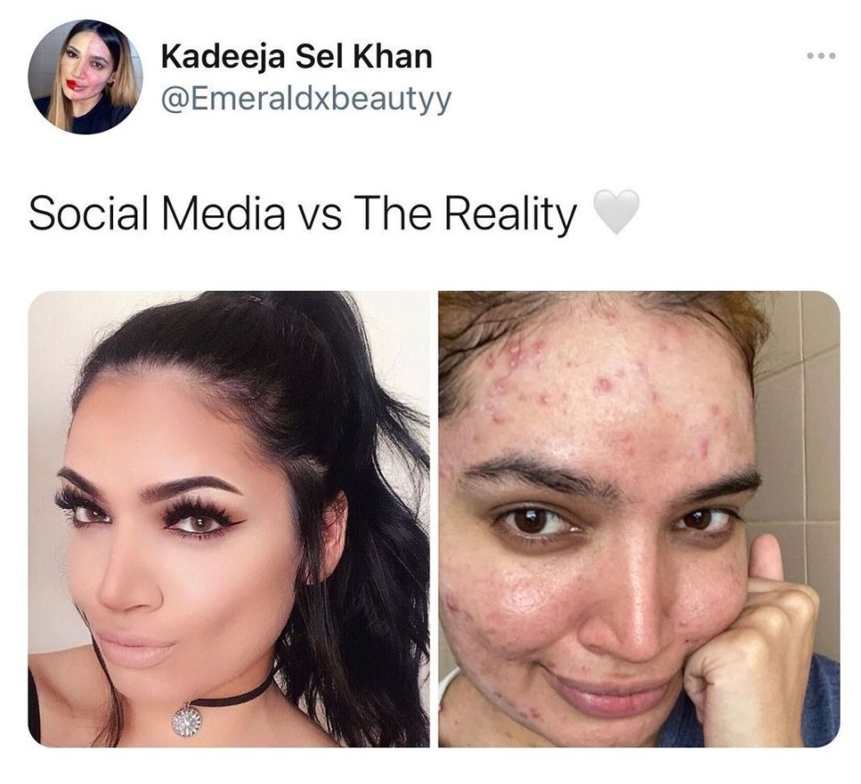 At the age of 20 she decided to drop filters and embrace her acne