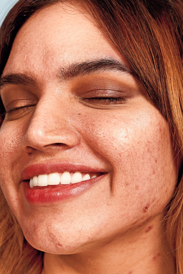 Kadeeja Khan has struggled with acne since the age of 11