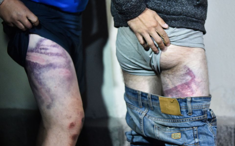 The bruised legs of men who were released from the Okrestina prison in August