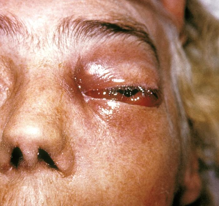 Picture of the fungal infection mucormycosis affecting someone's eye. This is not in a Covid patient, but it presents the same way