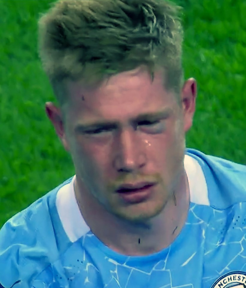 De Bruyne's eye soon blackened after the painful thud