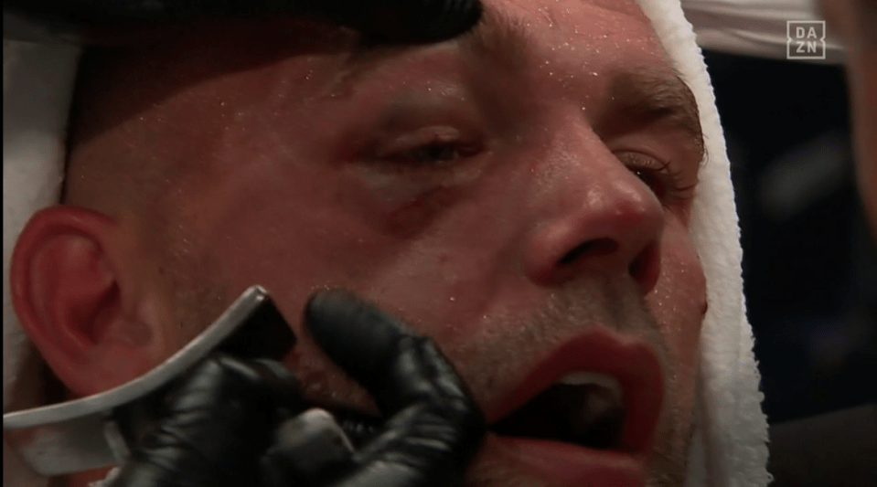 Billy Joe Saunders surrendered with an eye injury