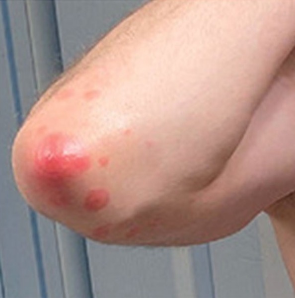 People have reported getting skin reactions after having Covid jabs