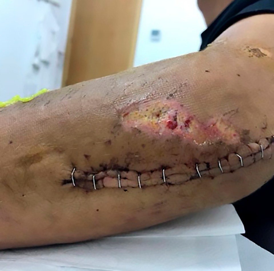 Spaniard Luis Leon Sanchez's arm after he crashed into a sign post during the Tour de France