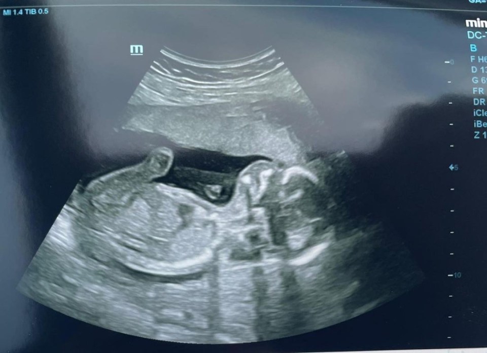 Danny Miller and Steph shared the first scan of their baby