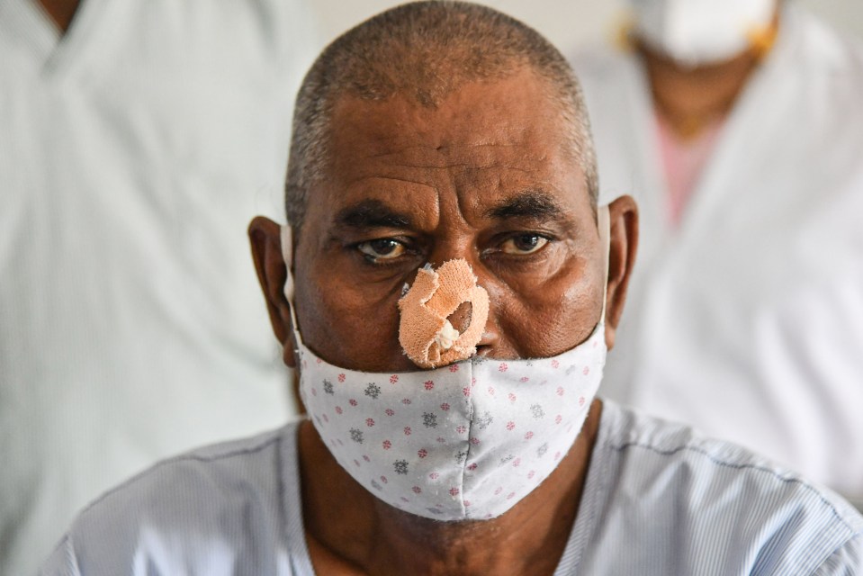 Removal of the eyes, teeth and other infected tissue in the face is a standard procedure for black fungus. Pictured: A man in Ajmer, Rajasthan, after having parts of his nose operated on