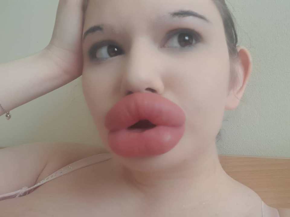 Extreme effort to have world's biggest lips