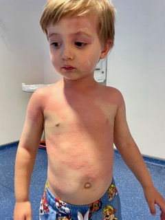 Eden, three, developed a rash