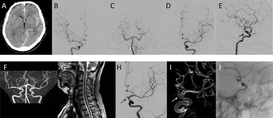 These scans were published in the report, showing the eruption of a brain aneurysm