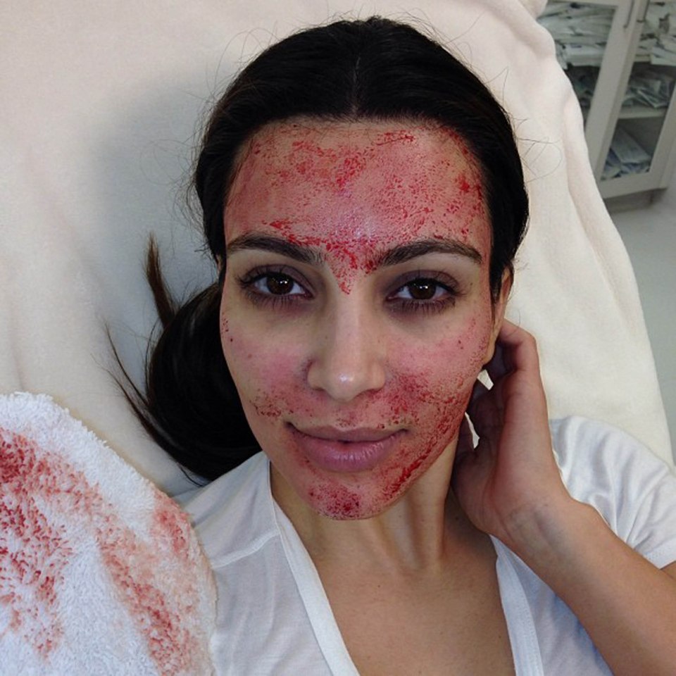 Kerry had the vampire facelift in 2013, which was promoted by Kim Kardashian