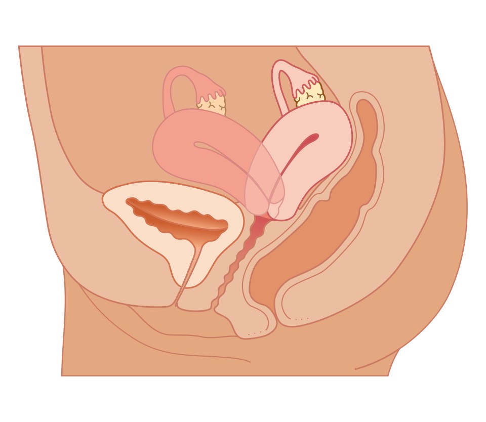 A retroverted uterus is one which tilts backward (faded) when it should be upright or slightly forward