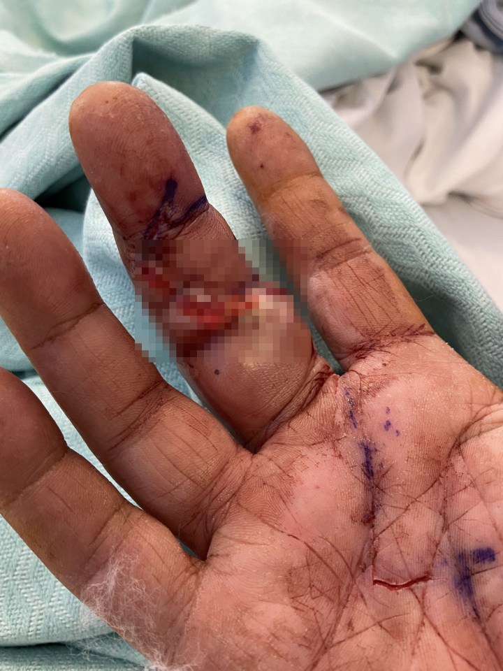 Phillip's finger ended up painfully swelling following his suspected false widow bite