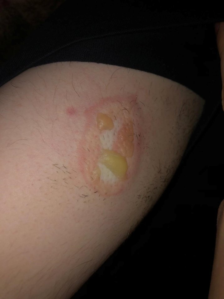 Carl Jones' bite baffled doctors when he showed them the pus-filled blisters on his arm