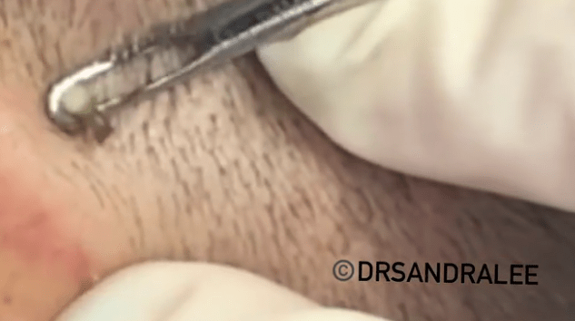 Dr Sandra pushes down on the skin, then the gunk starts to come out of the patient's face