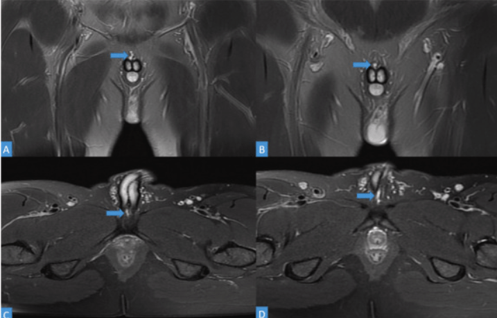 MRI scans showed the man had torn the suspensory ligament, which sits at the base of the penis (pictured with an arrow). Top two images are front on, and bottom two are looking downwrads