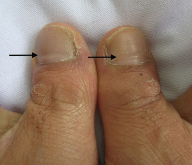 Ridges on the toenails of a man who had Covid three months prior