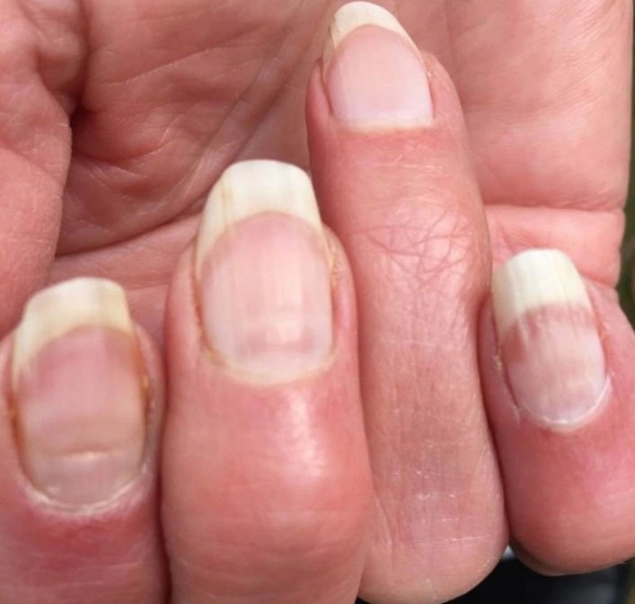 Prof Tim Spector highlighted this nail issue in May