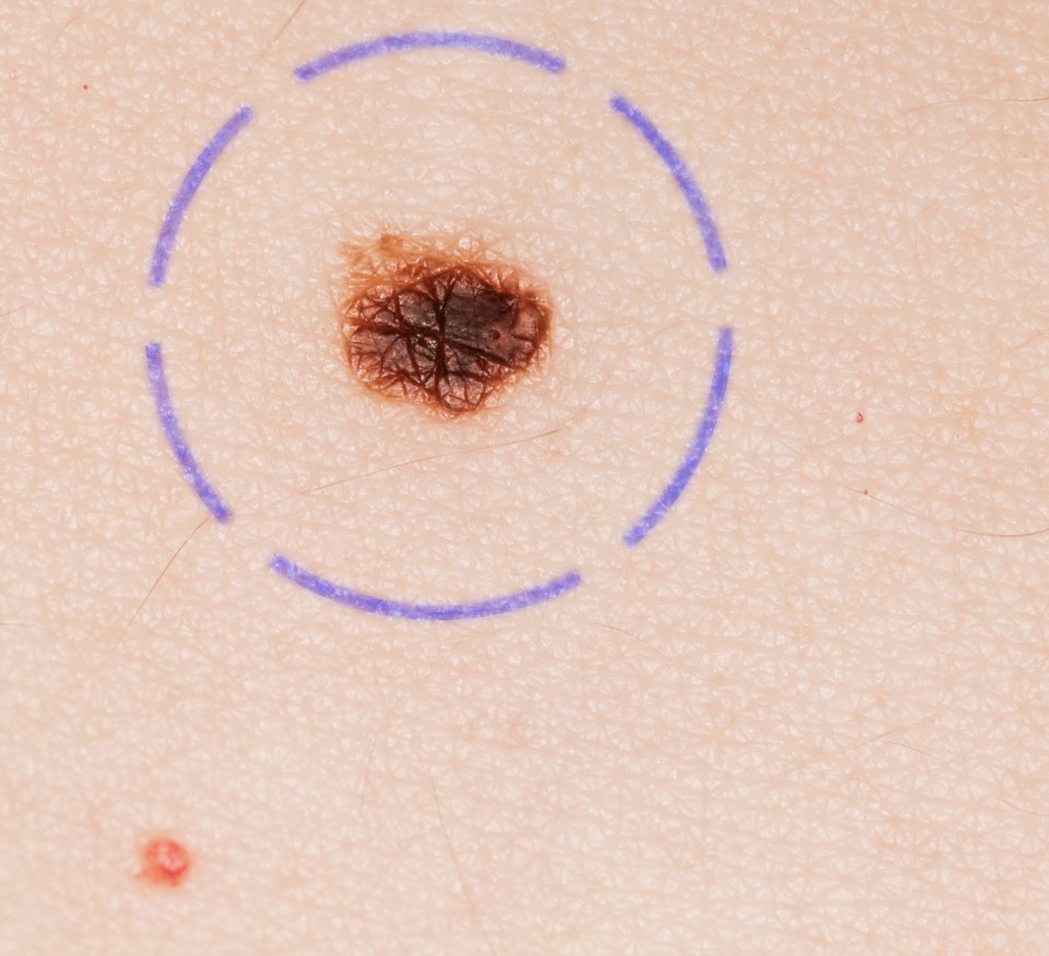 An example of a melanoma (file photo)